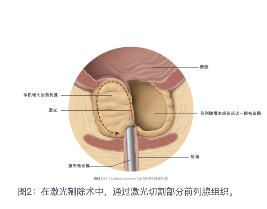 前列腺增生手术知多少三经尿道前列腺激光剜除术及术后注意事项