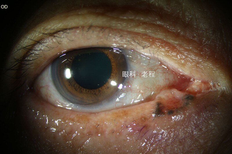 眼皮小小的肉芽须当心可能是眼睑癌的早期表现