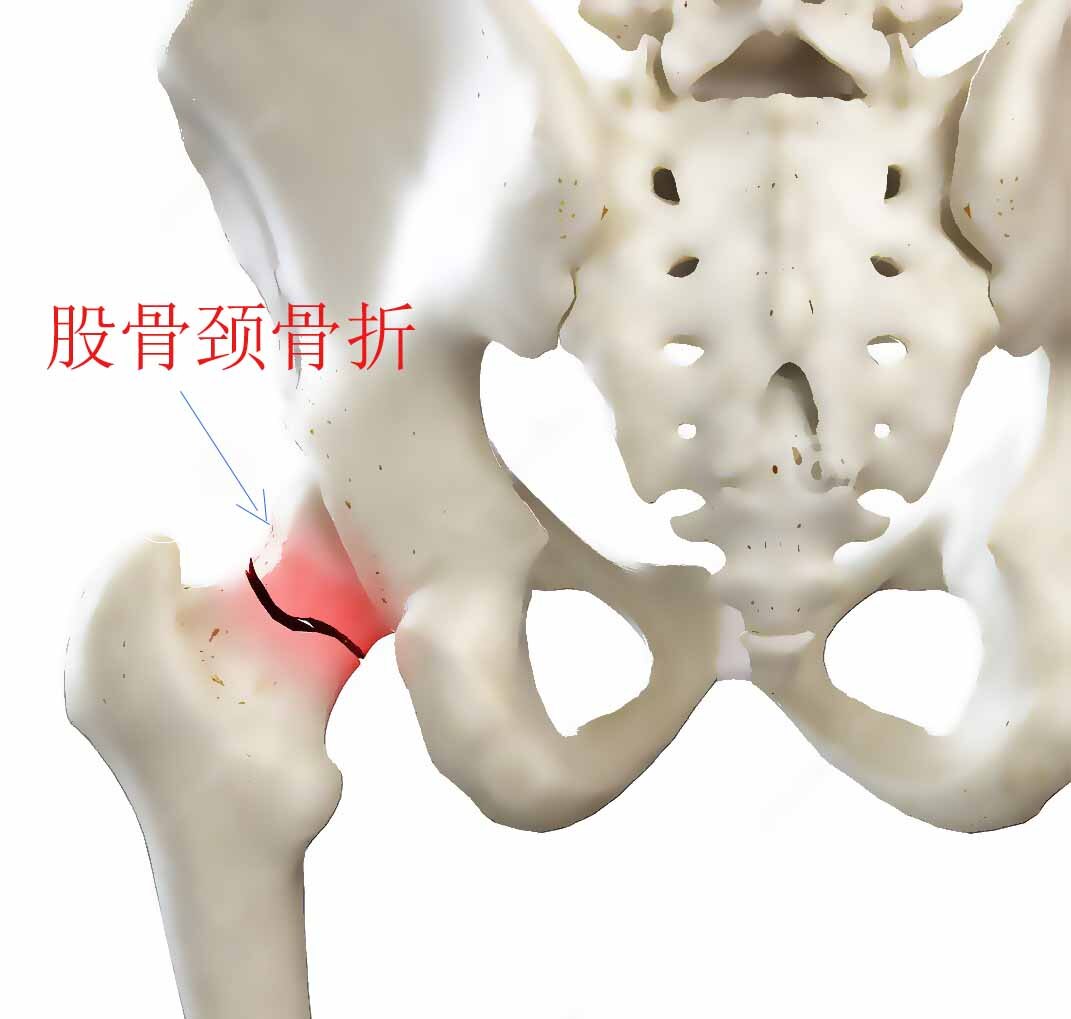 股骨颈骨折常见问题(一):影响股骨颈骨折愈合的因素有