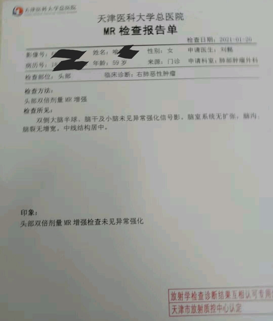 刘懿博士说肺癌一七七五肺癌术后颅脑ct发现问题担心转移怎么办