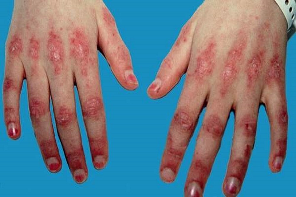 这些皮肤病需要警惕内脏恶性肿瘤!——皮肤上的癌症密码之六:皮肌炎