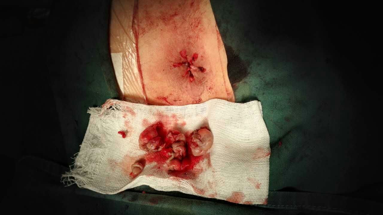 痔疮前后对比,微创源于手术艺术