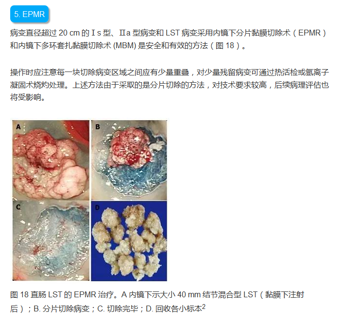 图文详解:结肠息肉切除术