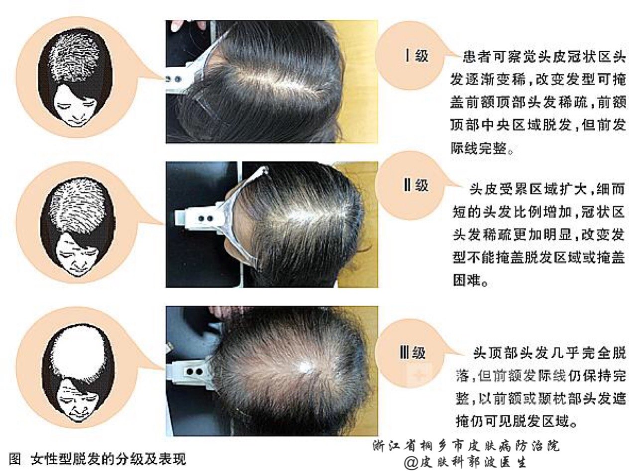 脂溢性脱发(秃顶):并不是男性的专利!_好大夫在
