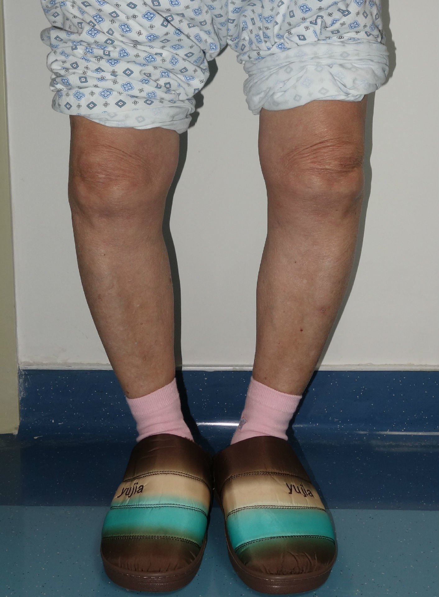 “独腿老人”骨髓炎复发，医生帮他清除骨感染还将“罗圈腿”伸直了_左腿_手术_膝关节