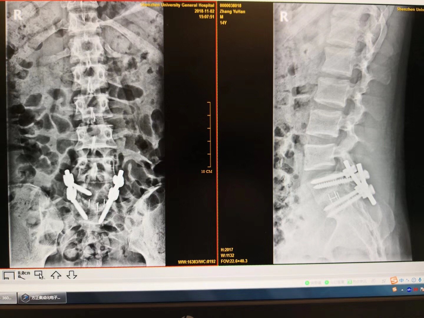 腰椎滑脱症案例解析