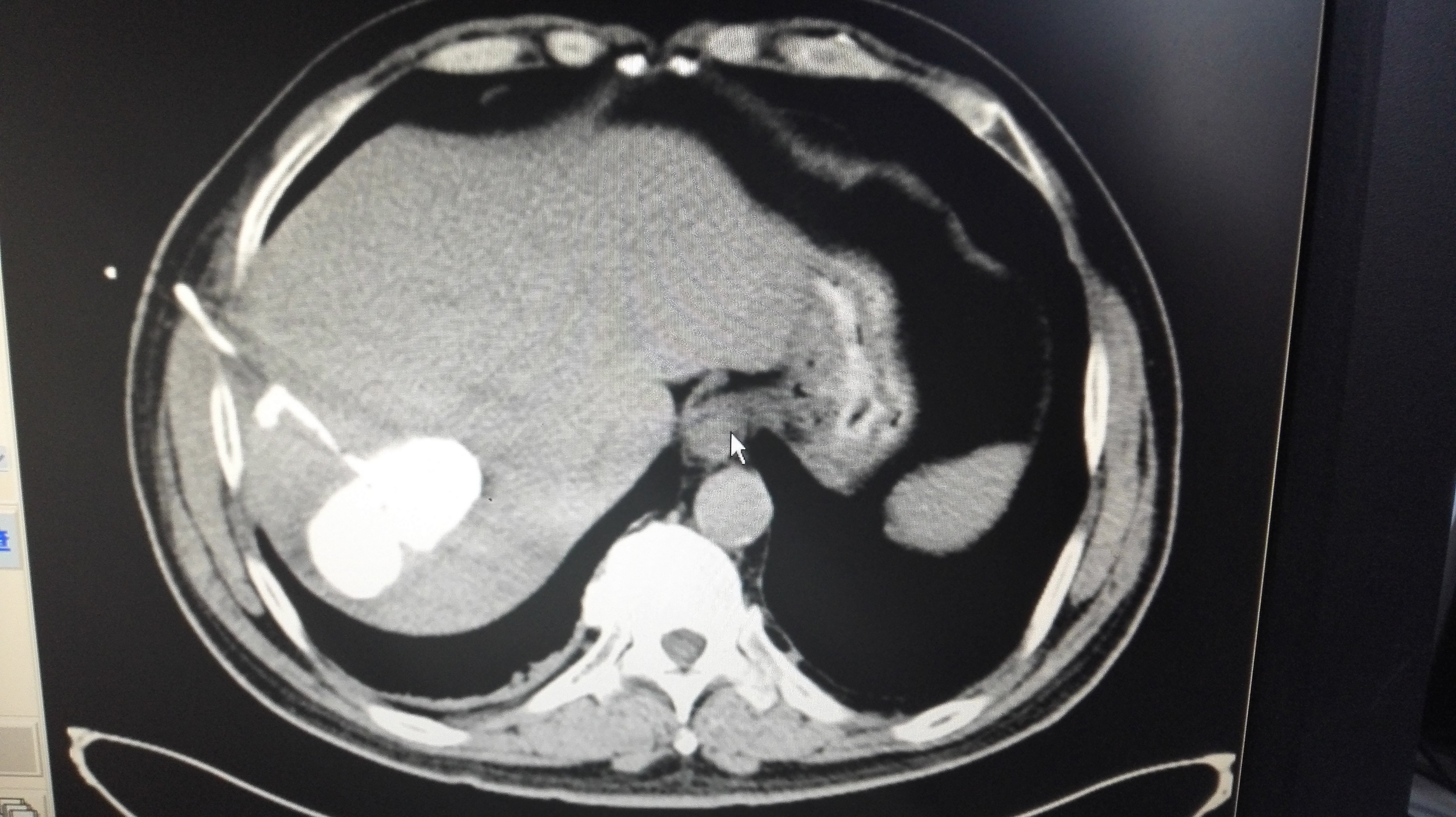 肝囊肿怎么治?聚桂醇硬化治疗帮您忙 - 好大夫