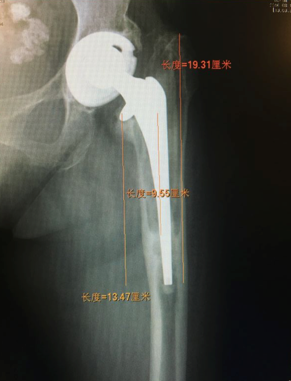今天做了一例髋关节翻修手术体会