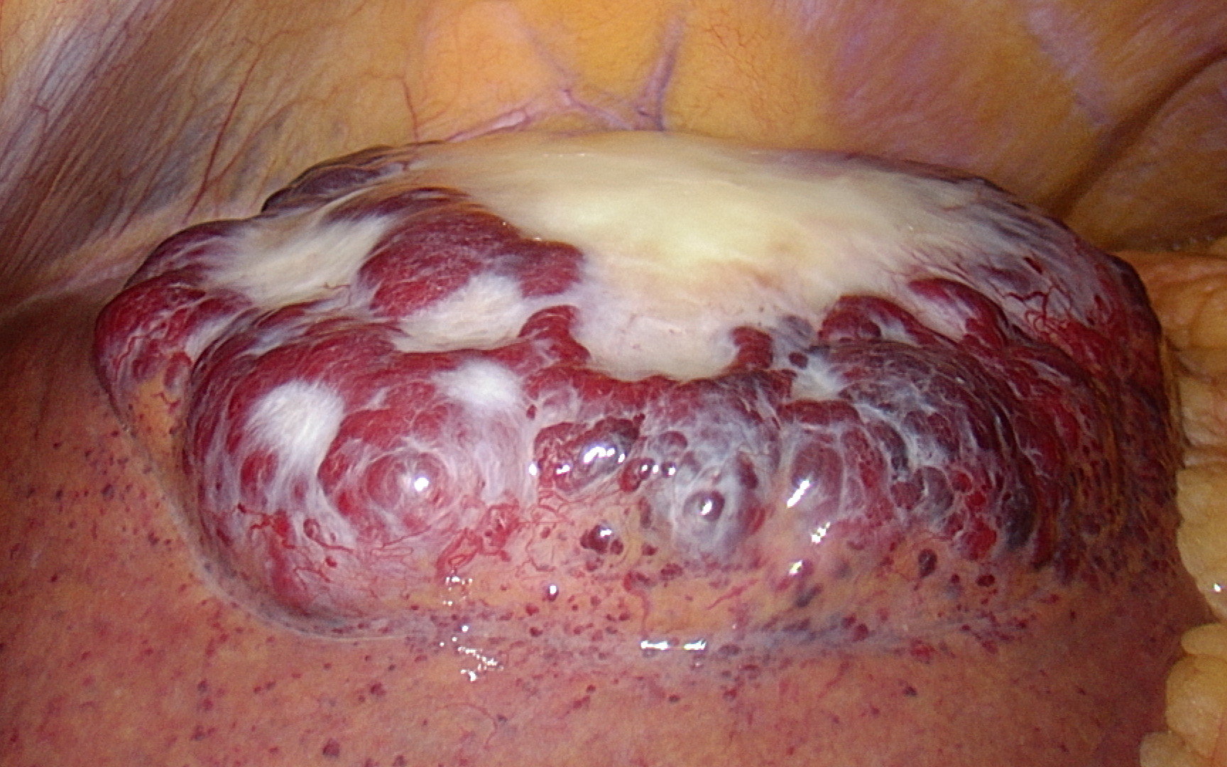 图为腔镜下肝血管瘤位于左肝外叶,直径约9公分.