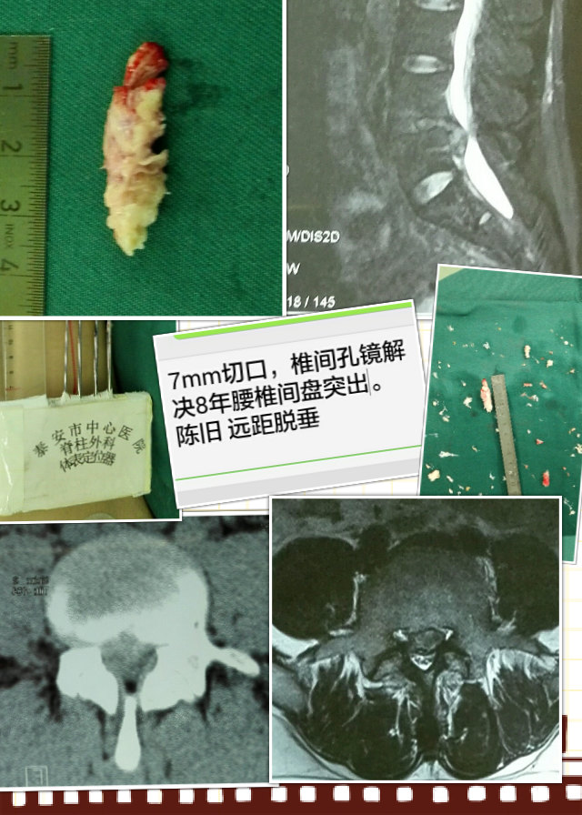 腰椎间盘突出症 的微创 椎间孔镜 治疗 - 好大夫