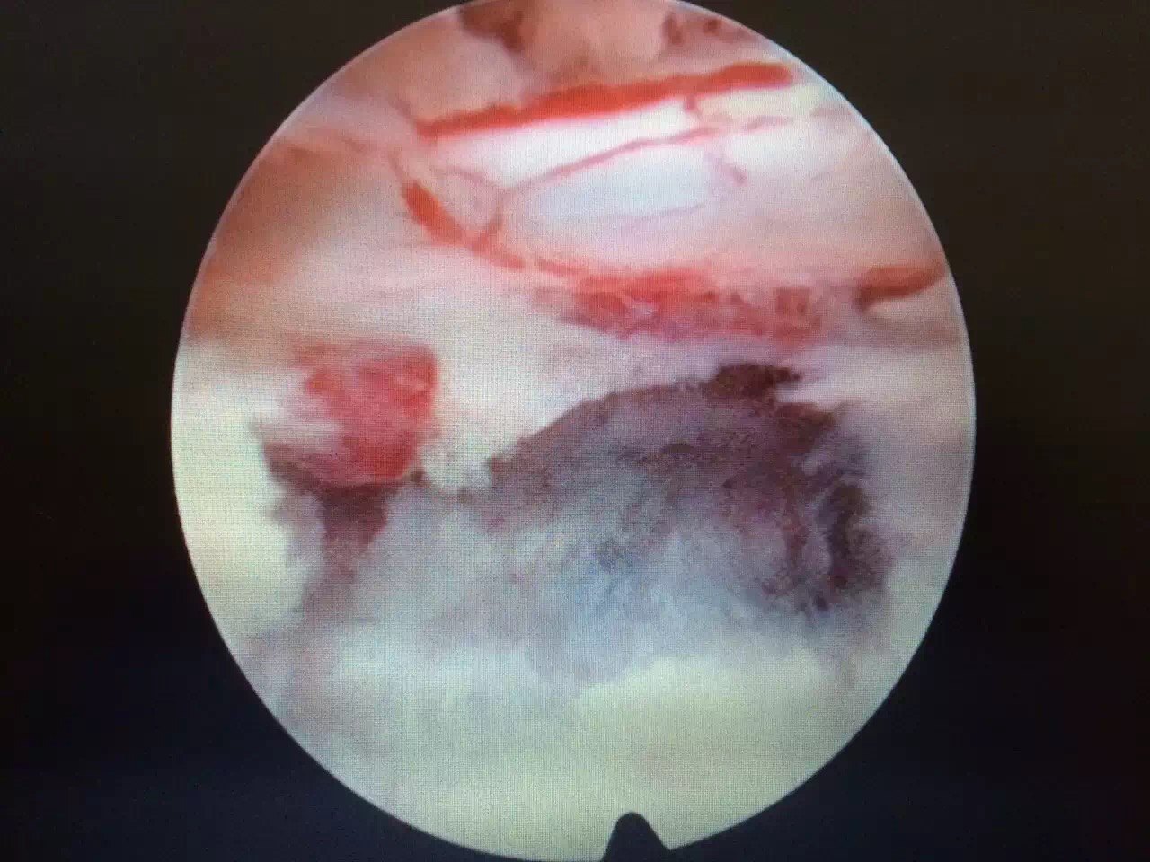 巨大型腰椎间盘突出症的微创手术治疗