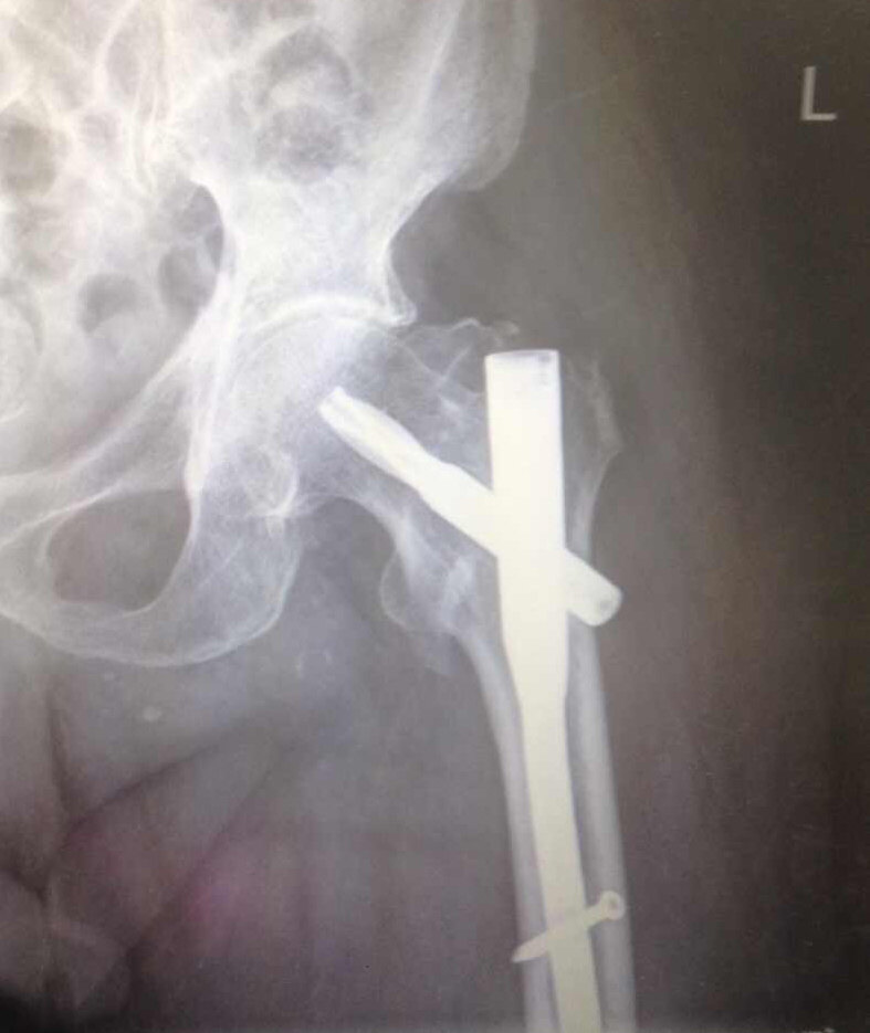 老年性髋部骨折的预防和治疗体会