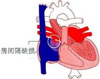 先天性心脏病