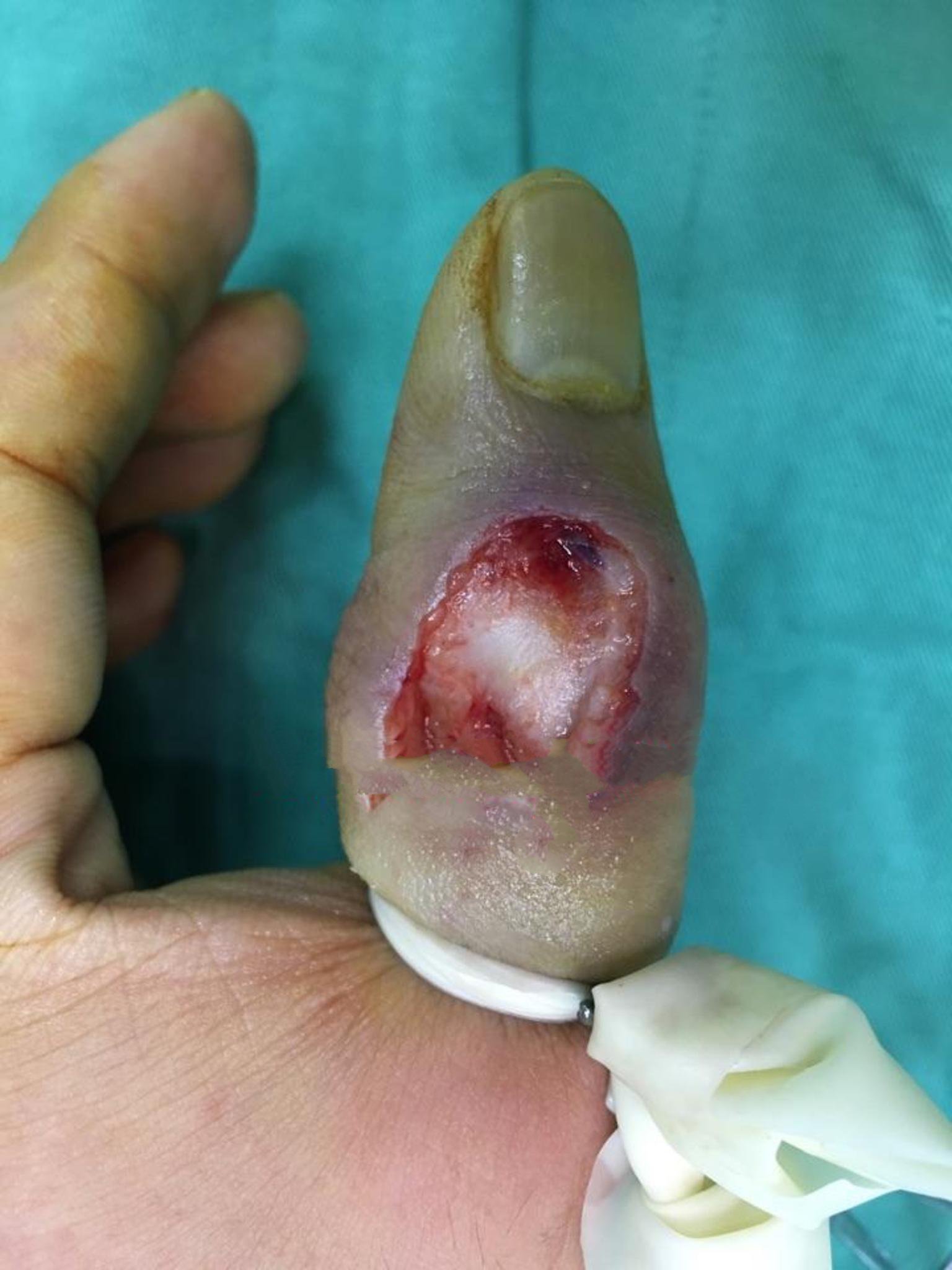 手指皮肤缺损可以不植皮长好吗需要注意哪些