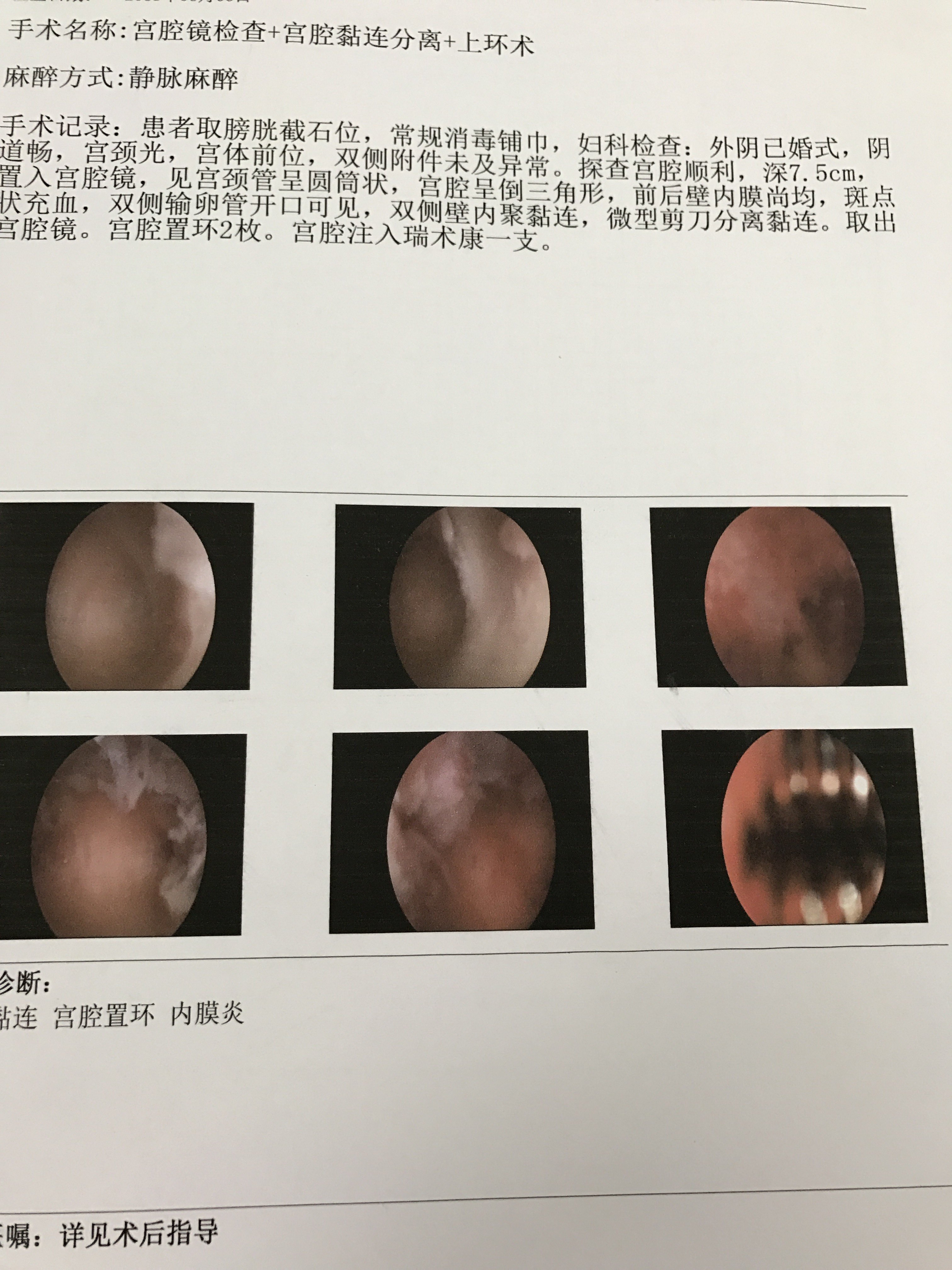 乐仁东生 楼晓芳 文章列表 >楼医生宫腔镜手术案例七   取环术后一个