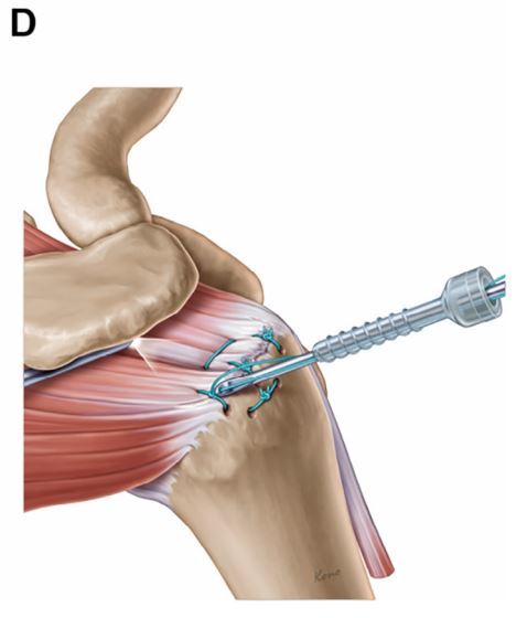肩关节镜下穿骨固定治疗肩袖损伤是怎么进行的
