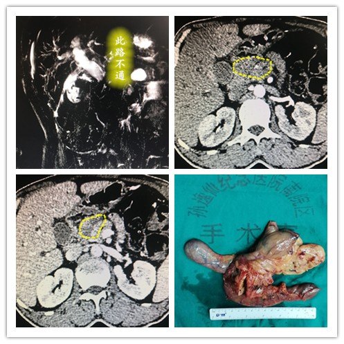 外院ct提示:胆总管胰头段恶性肿瘤.