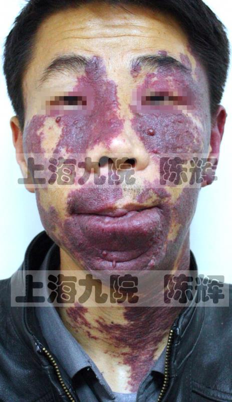 葡萄酒色斑/鲜红斑痣——就诊必答12问(多图详解)