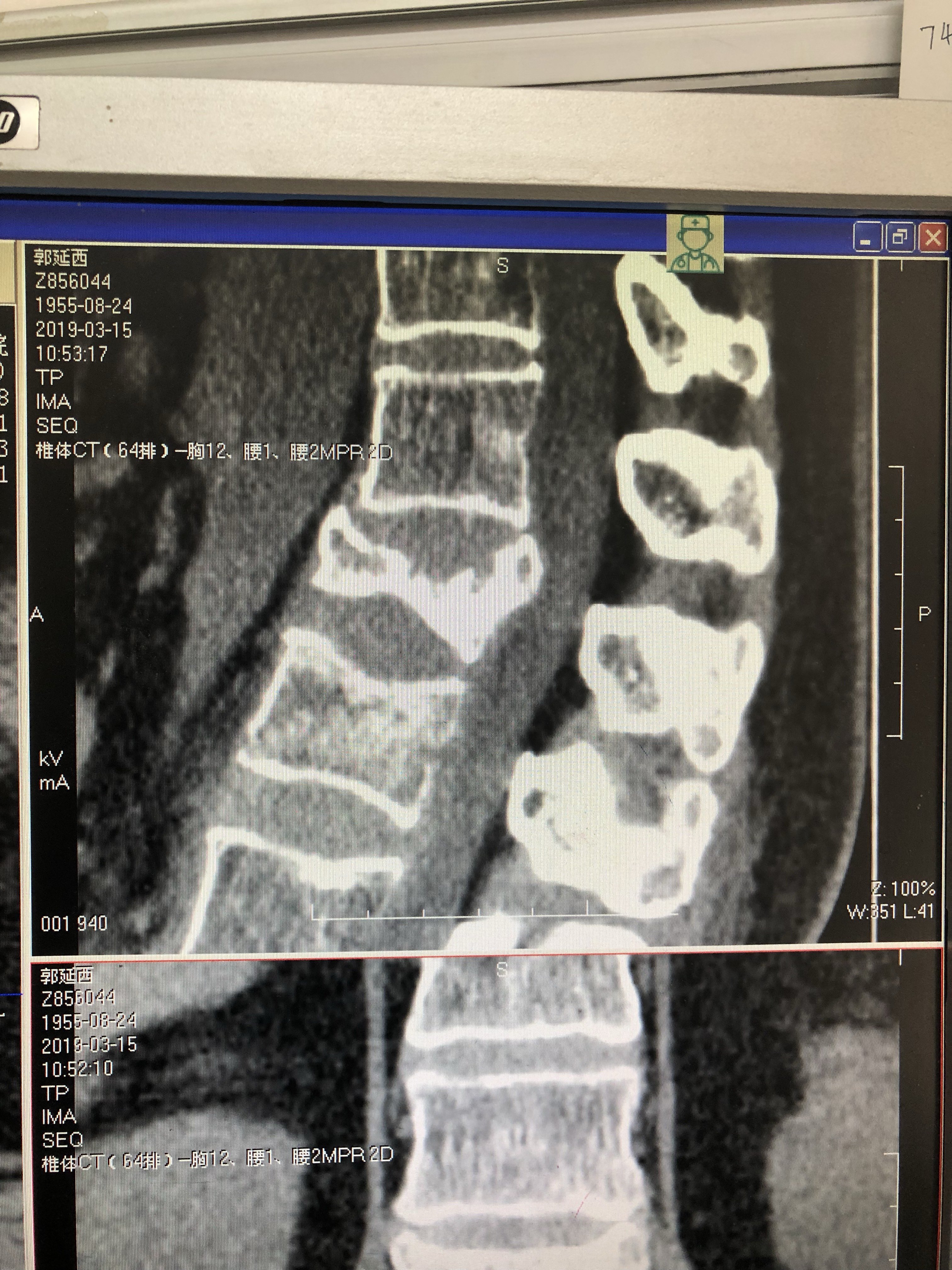 陈旧性腰椎骨折pso截骨矫形术
