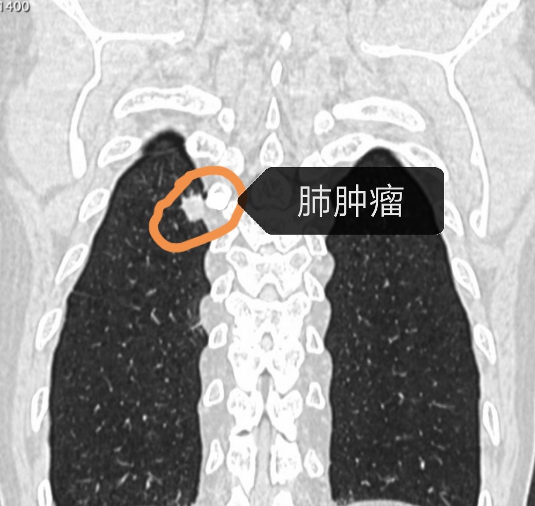 胸片检查没事,为什么却诊断肺肿瘤!