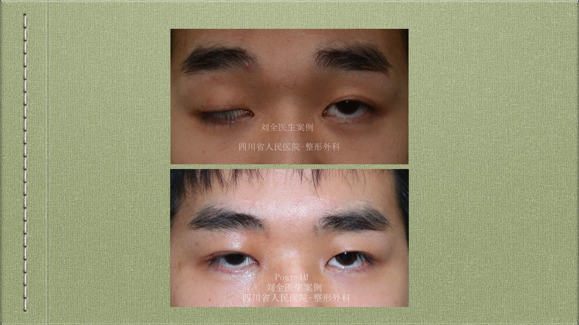 cfs～上睑下垂,用案例说话