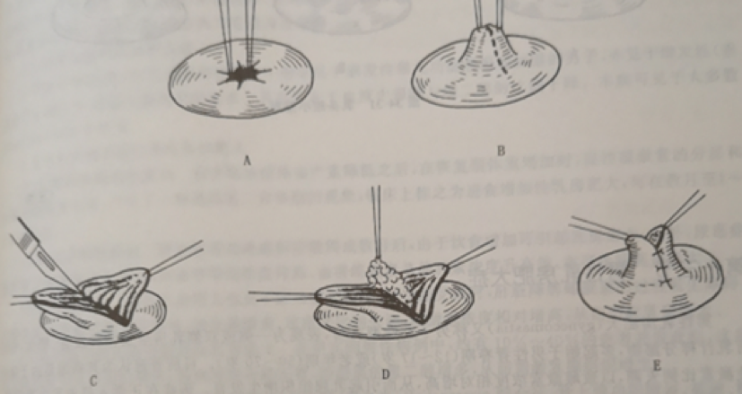 优点:手术简便,易于掌握,真皮瓣可增加乳头体积及乳头下支撑,使乳头