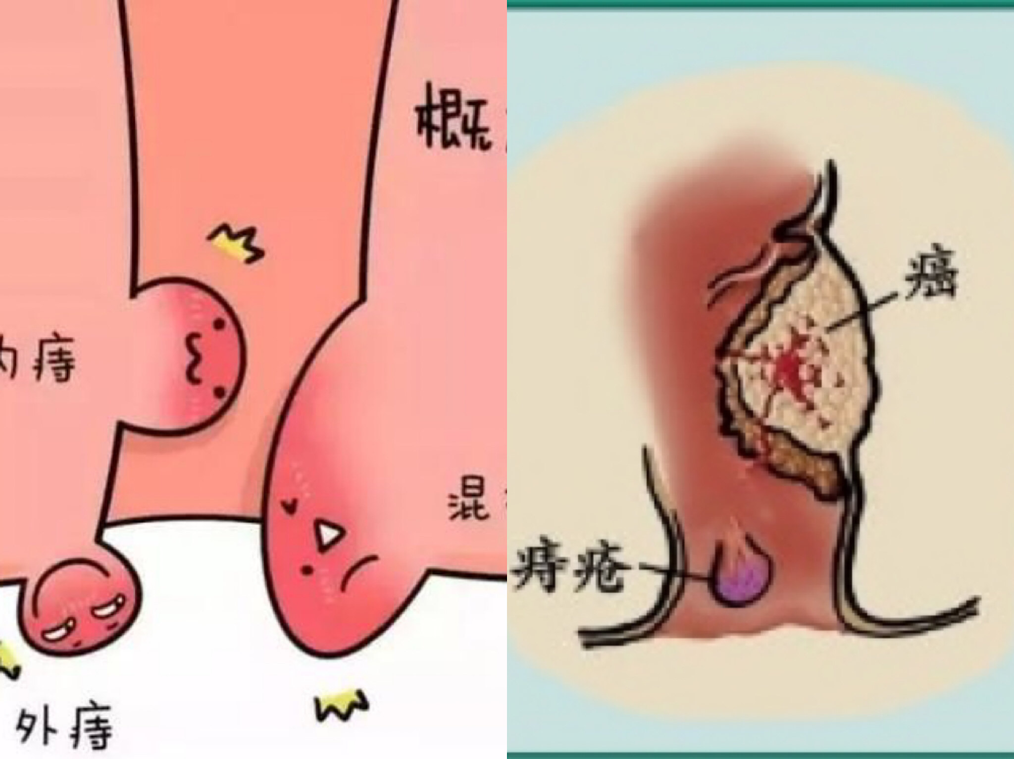 概述 痔疮是最常见的肛门疾病 直肠癌是较常见的癌症