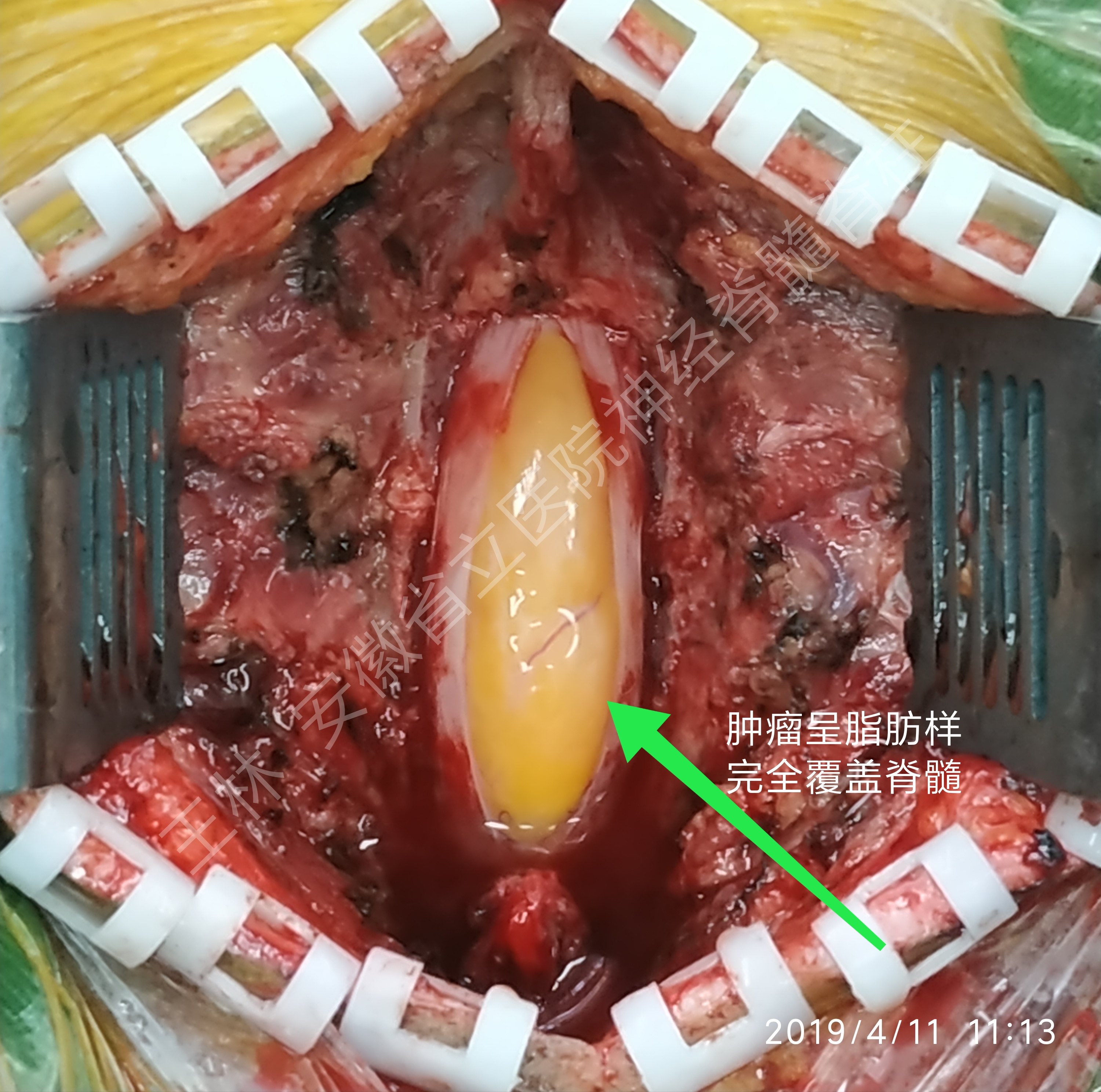 脊髓脂肪瘤