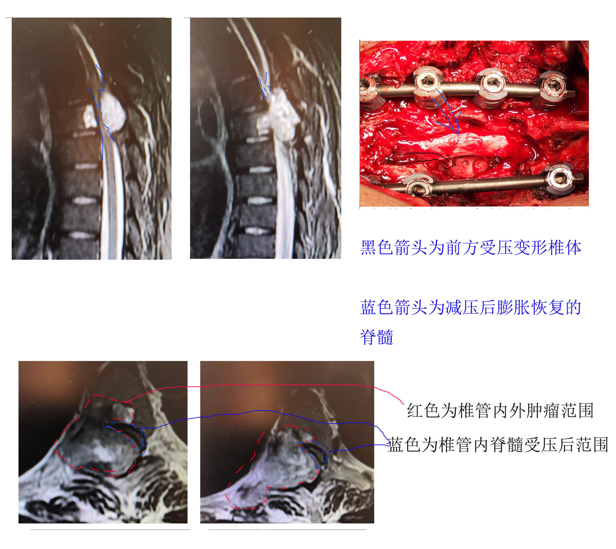 胸椎肿瘤瘫痪手术完整切除后恢复正常行走