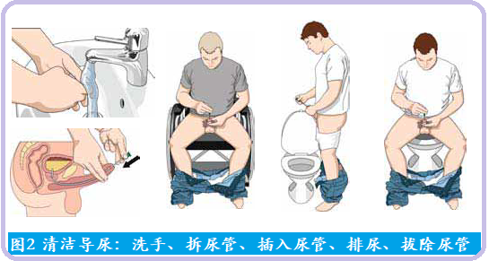 图2清洁导尿示意图.png