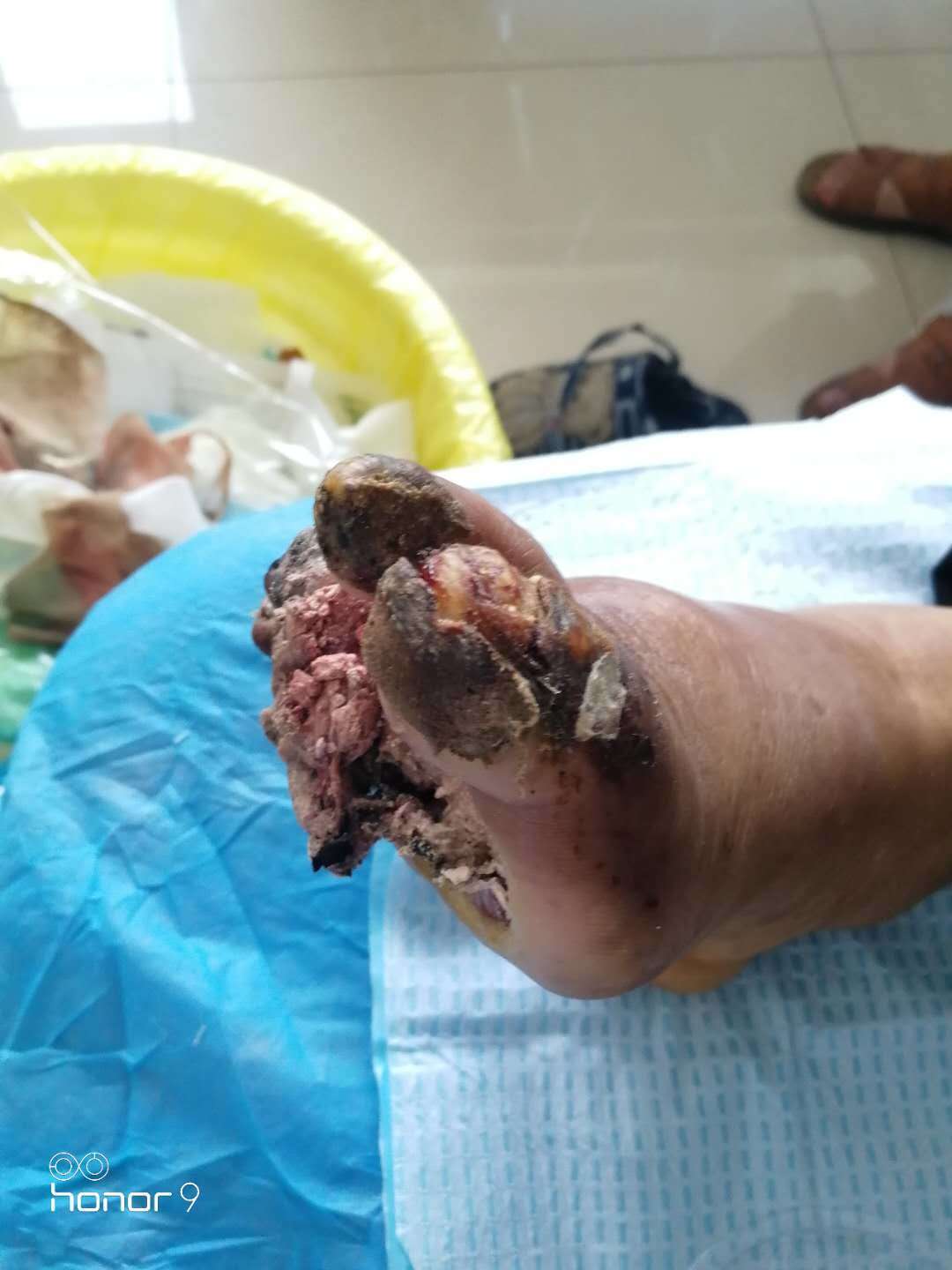 患者赵某,女,65y, 糖尿病 20年,既往血压高,合并下肢 动脉硬化 闭塞症