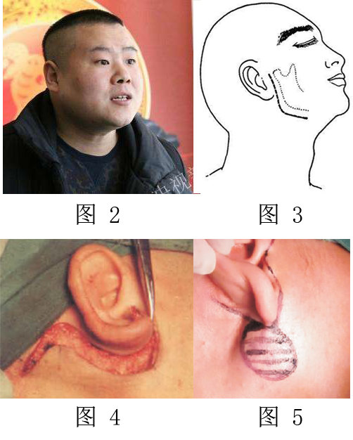 下图2是著名相声演员岳云鹏,他就曾经做过腮腺 肿瘤 的切除术,因为