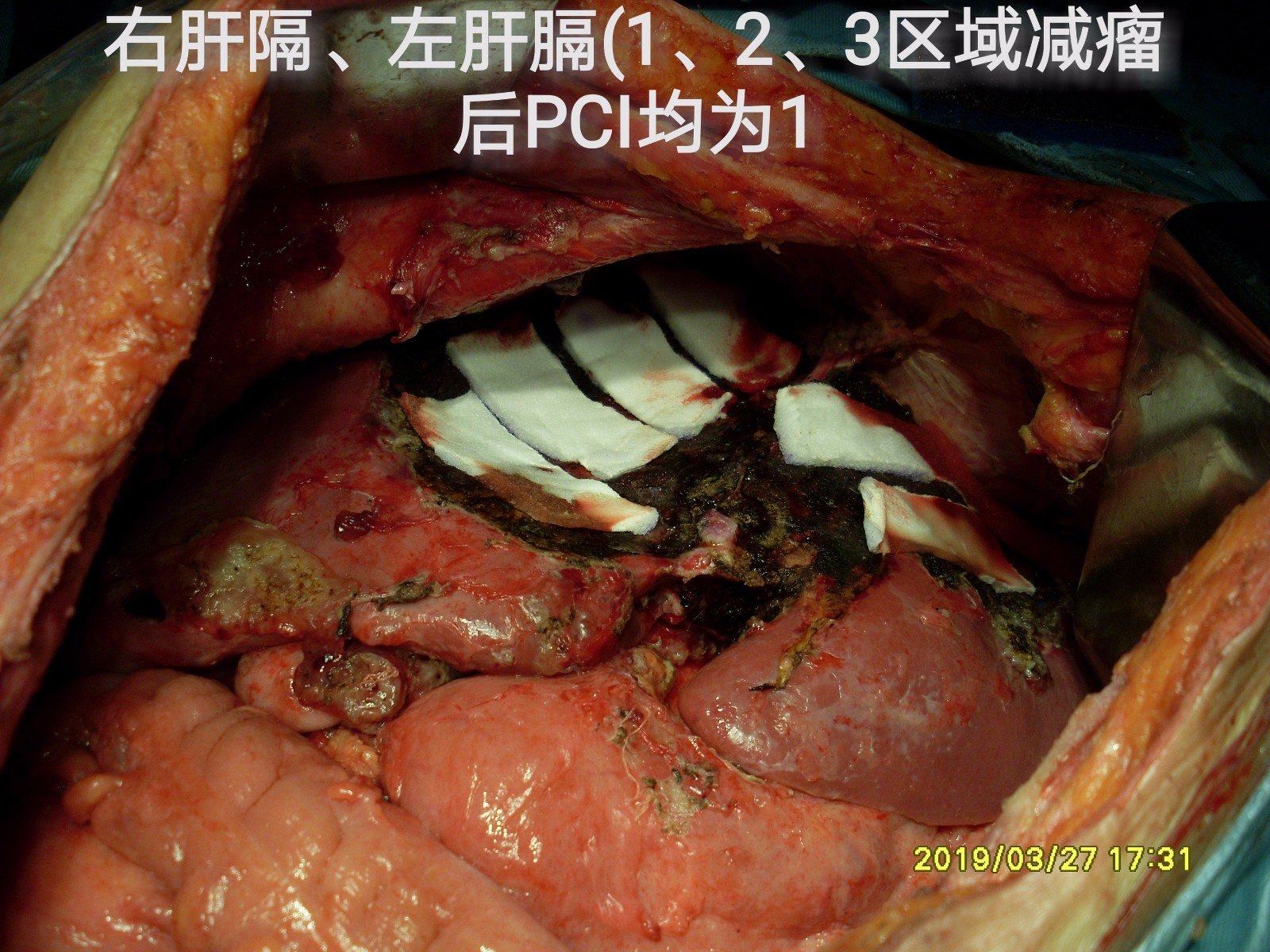 双附件区占位并腹腔广泛种植转移实为阑尾来源粘液性肿瘤治疗病例分享