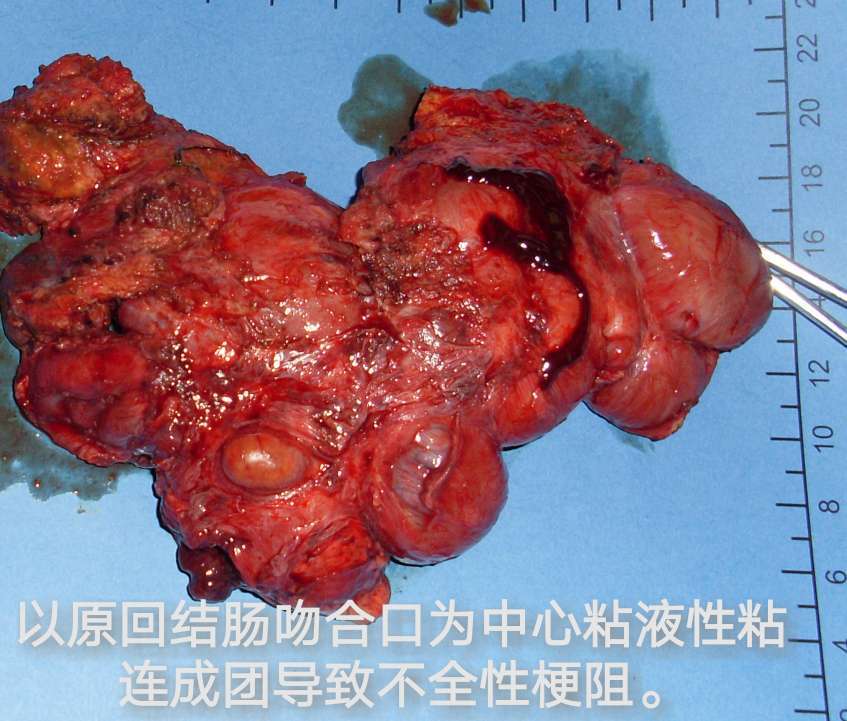 病例(36)--阑尾脓肿治疗中发现阑尾粘液性肿瘤pmp
