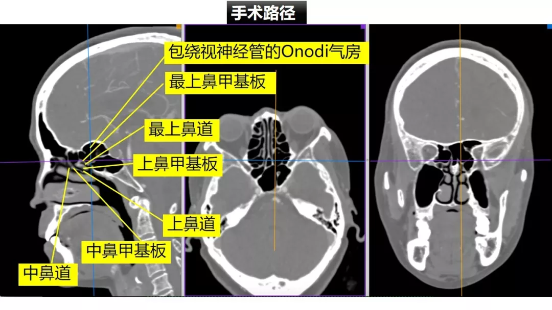 前床突磨除与脑积液漏处理-中鼻道经筛入路解剖,阅片与手术