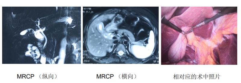 为什么在胆囊切除术前一定要做个胆道磁共振mrcp