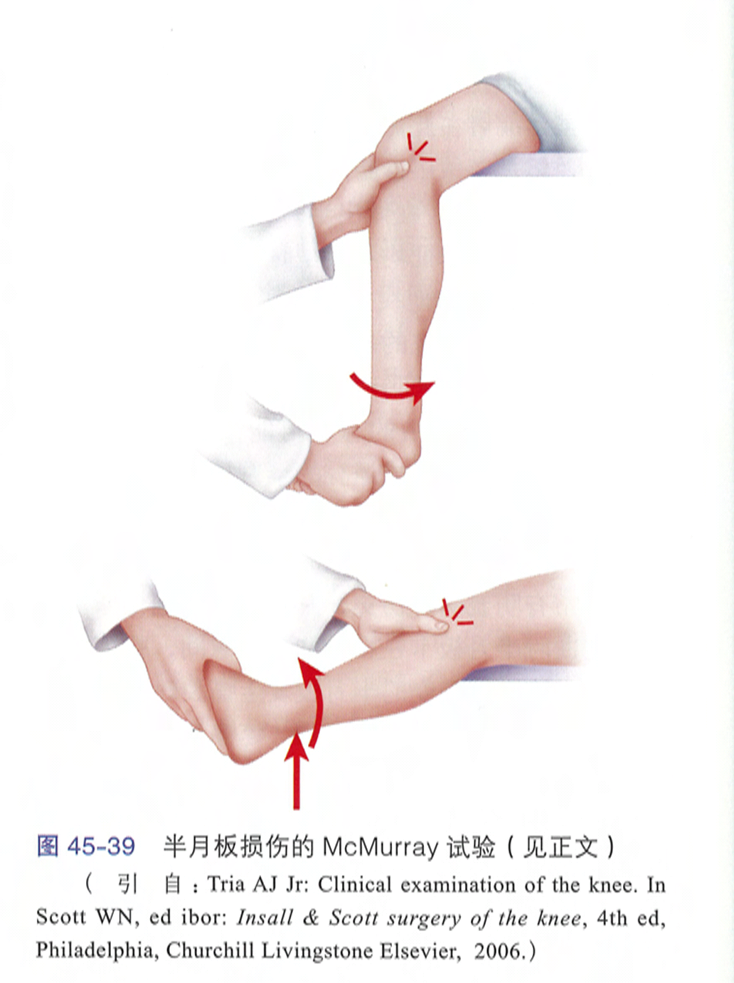 麦氏征(mcmurry's test)检查大多数为阳性,可进行定位,是最常用的检查