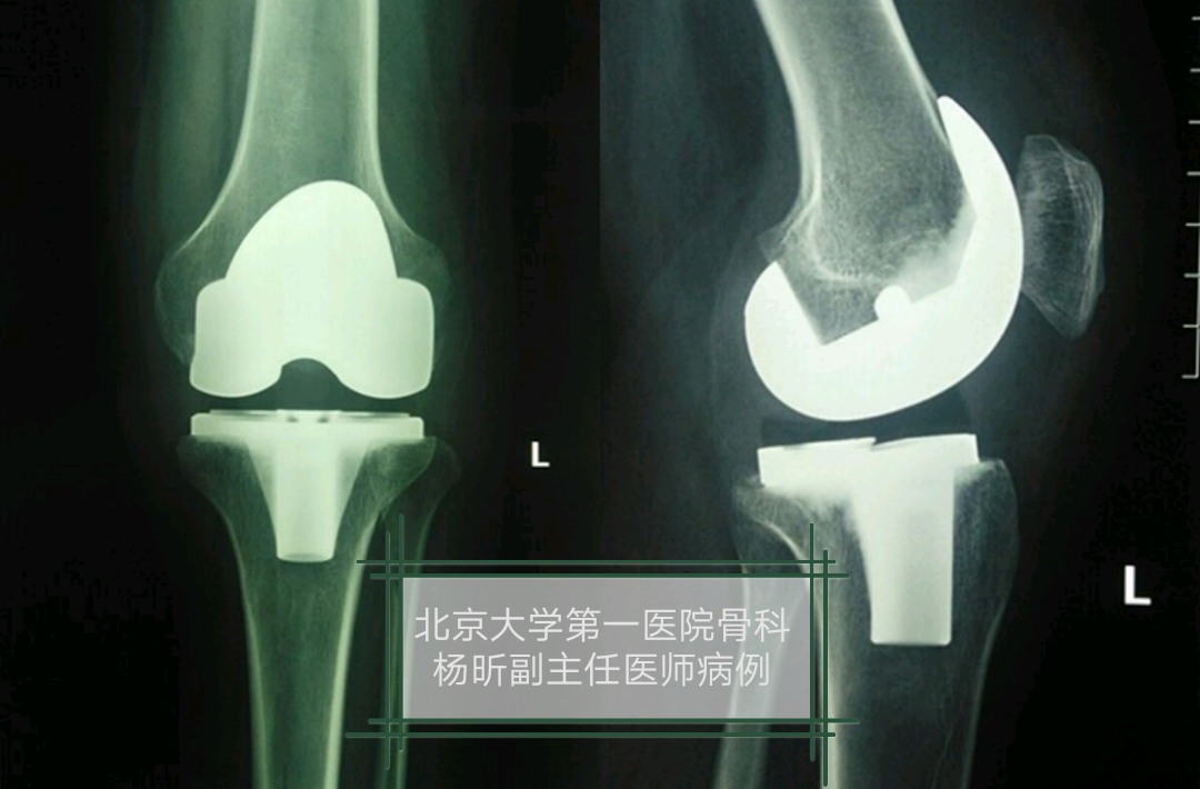 膝关节置换可怕吗