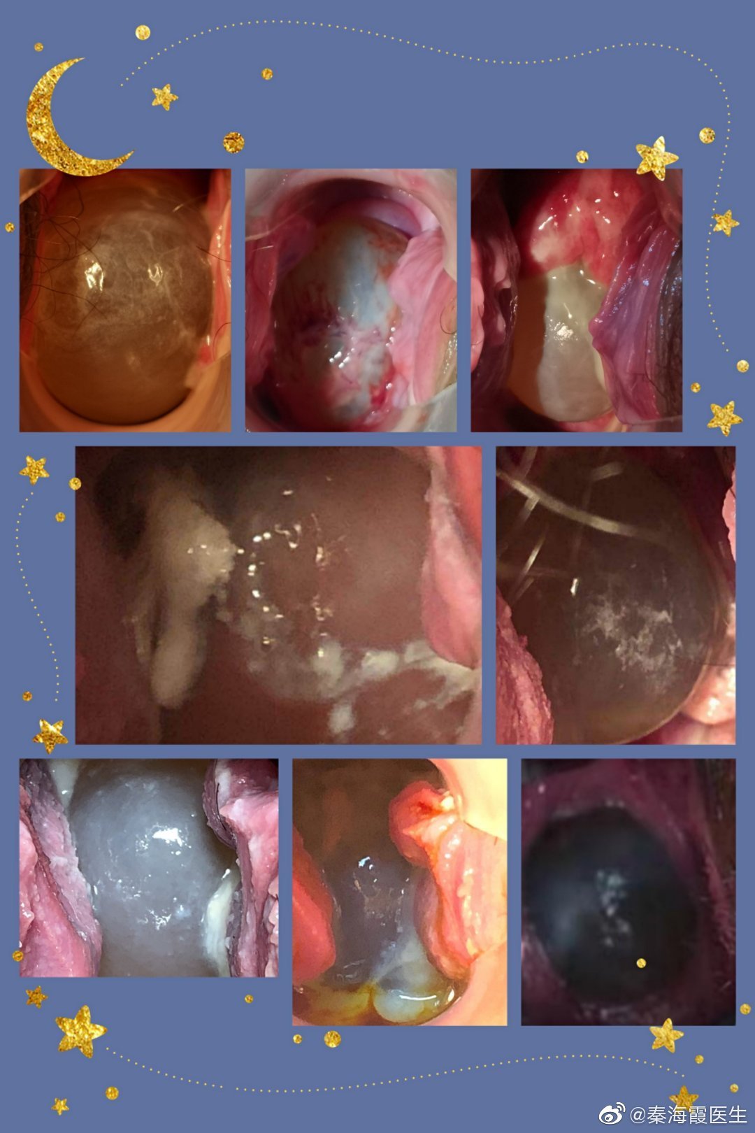 一根神仙线,助圆母亲梦_宫颈机能不全