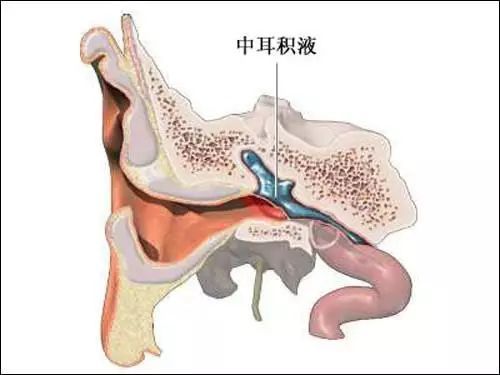 咽鼓管吹张治疗分泌性中耳炎