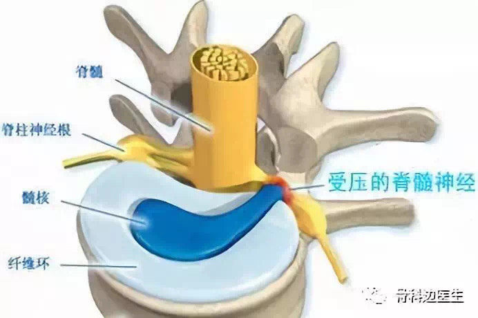 专业性解释:由于颈椎间盘,颈椎钩椎关节或关节突关节增生,肥大的骨刺