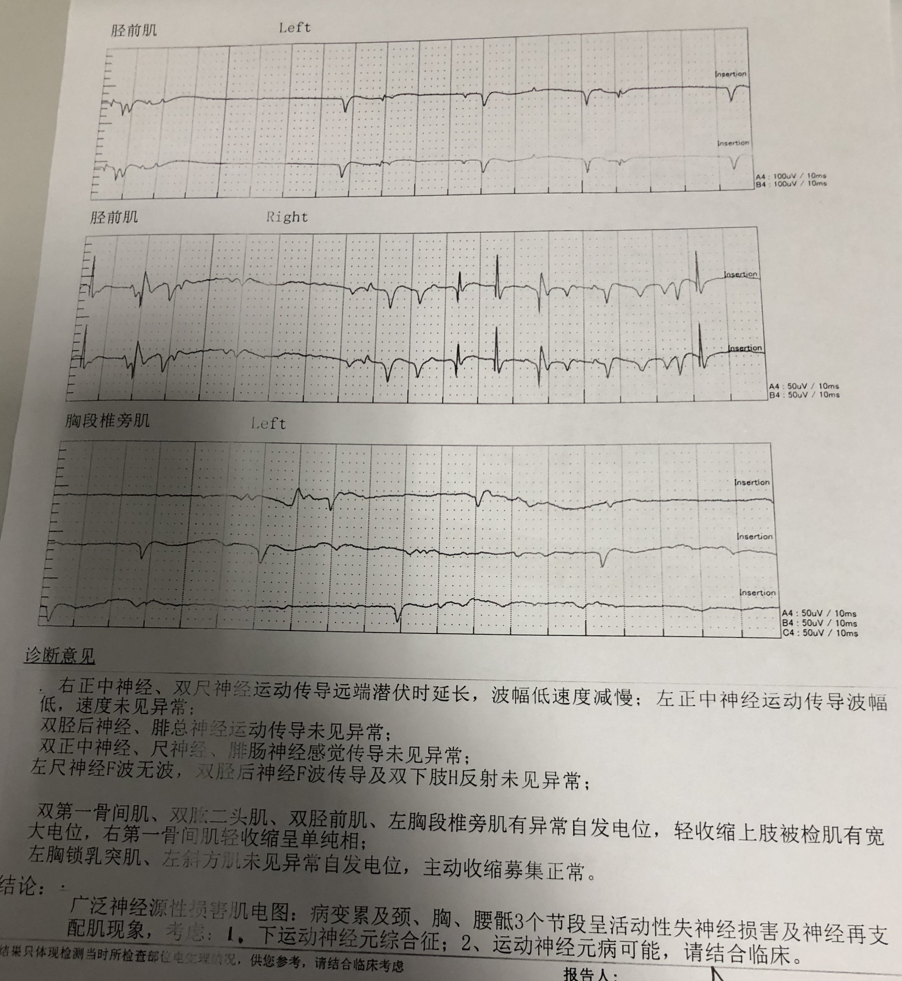 > 一个有关渐冻症(als)问题的回复