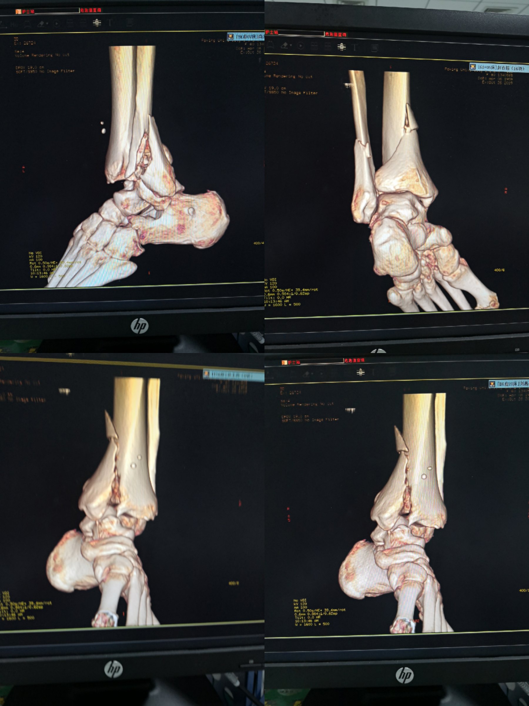 术前检查:踝关节正侧位x光片看力线,三维ct看关节面及骨折细节,踝
