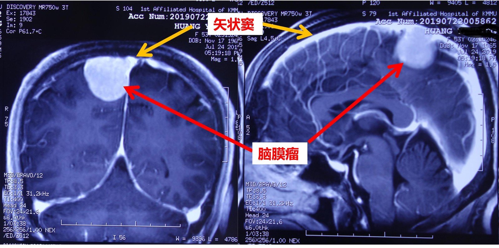 黄严平-矢状窦脑膜瘤-1.jpg