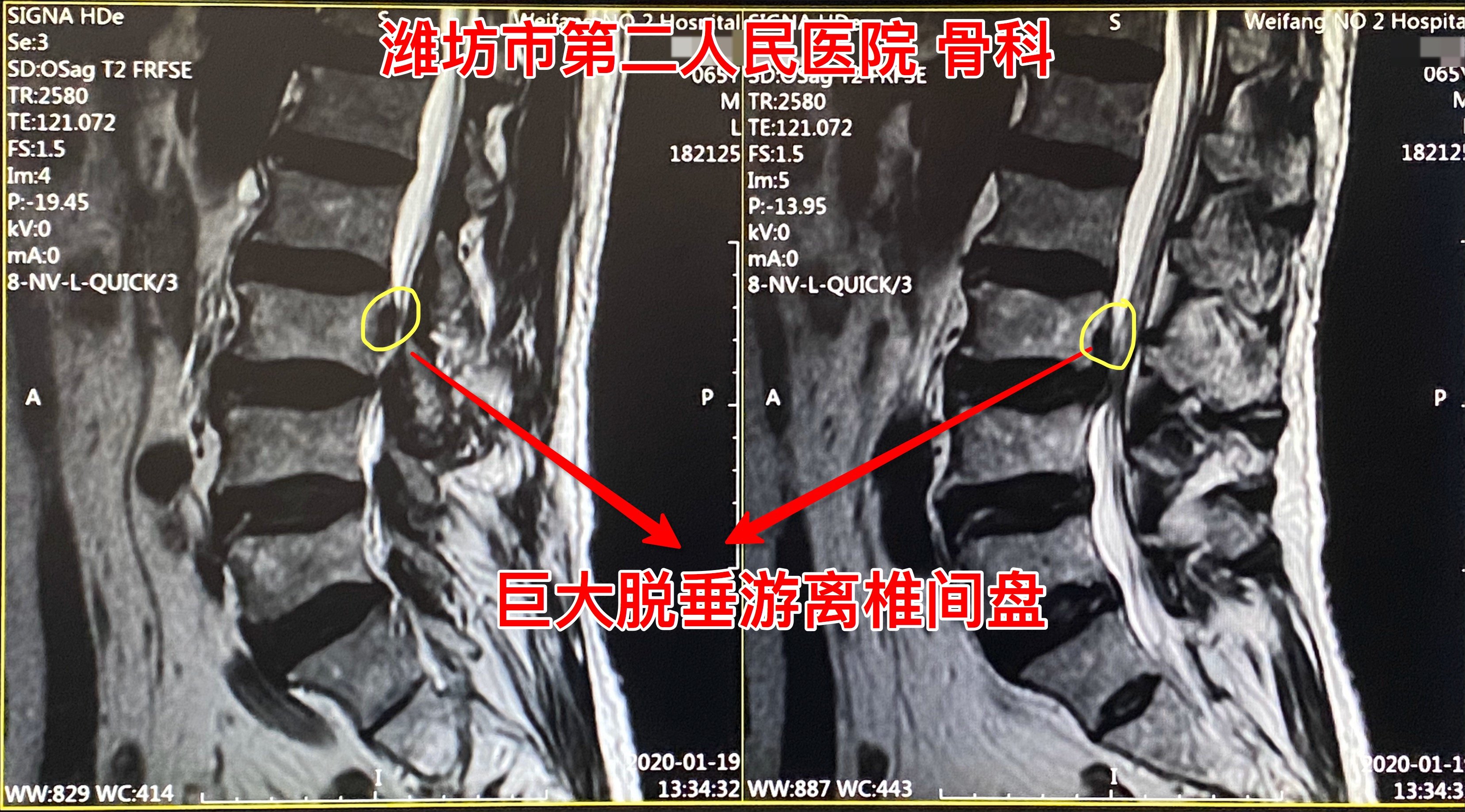 微创椎间孔镜一样可以胜任高度游离脱垂椎间盘突出症