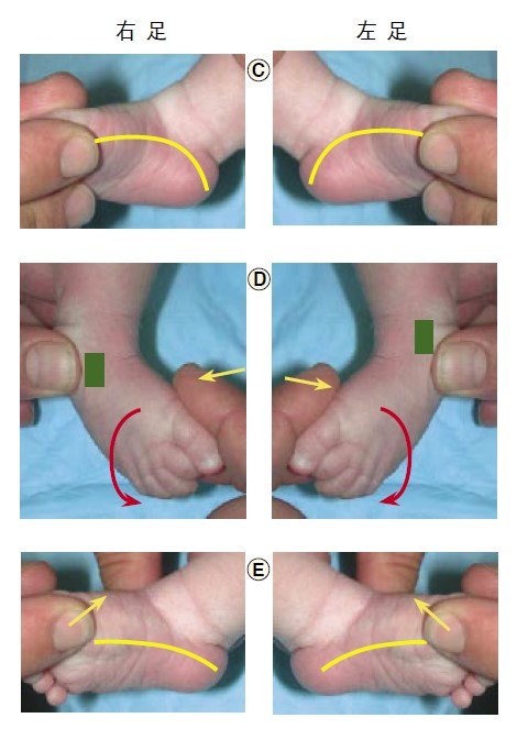 马蹄内翻足的畸形主要包括以下四点(cave): c(cavus)  高弓:前足相对