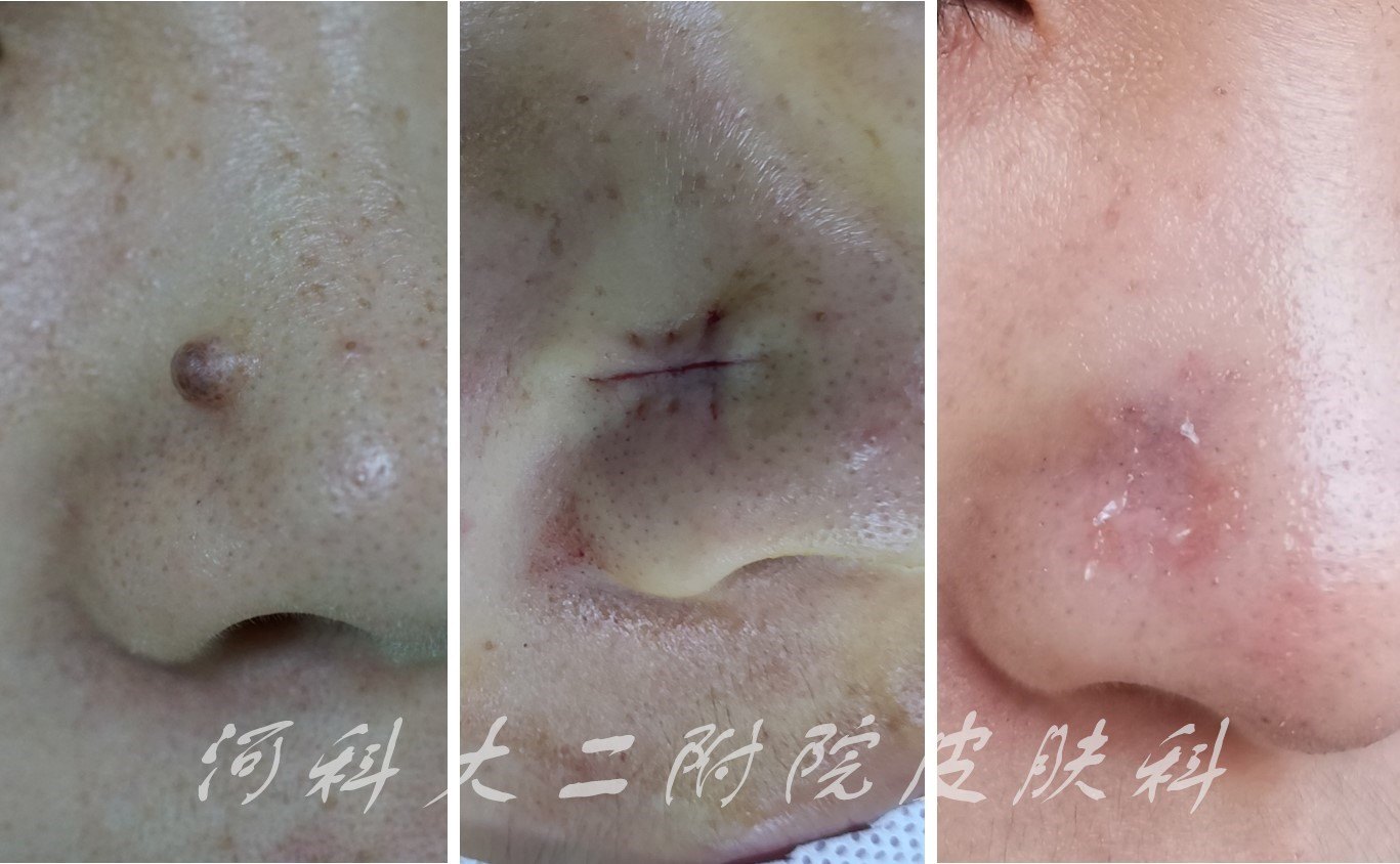 图三 鼻翼色素痣 影响美观 美容缝合后与术后7天对比