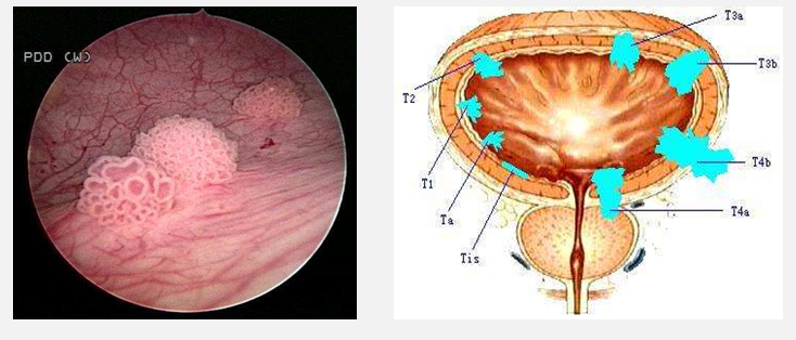 一项古老的新技术—膀胱癌的光动力疗法