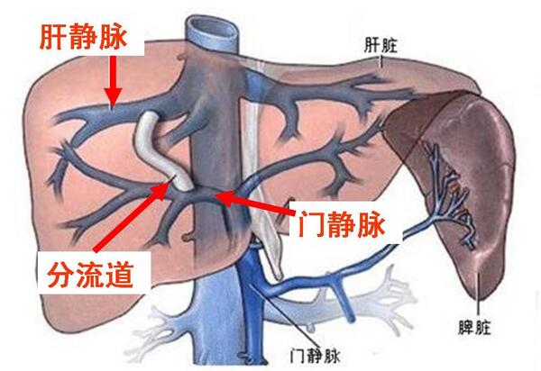 tips手术步骤的图片图片