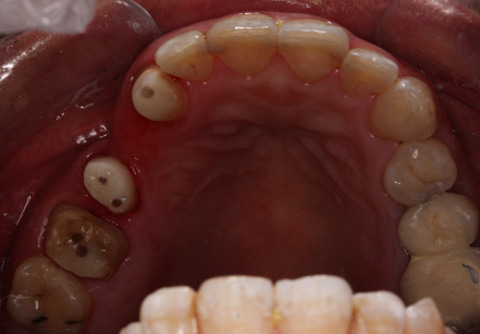 残根残冠应该怎样保存? - 好大夫在线